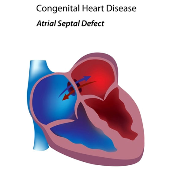 Atrial Septal Defect