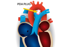 PDA Treatment 1